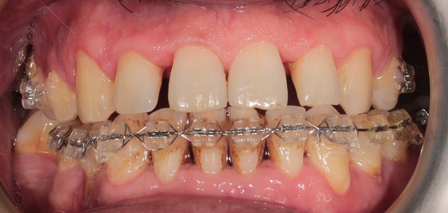 Üst çene ortodontik tedavi